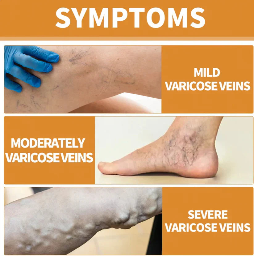 Turmeric Varicose Vein Relief Spray Buy 1 Get 1 Free
